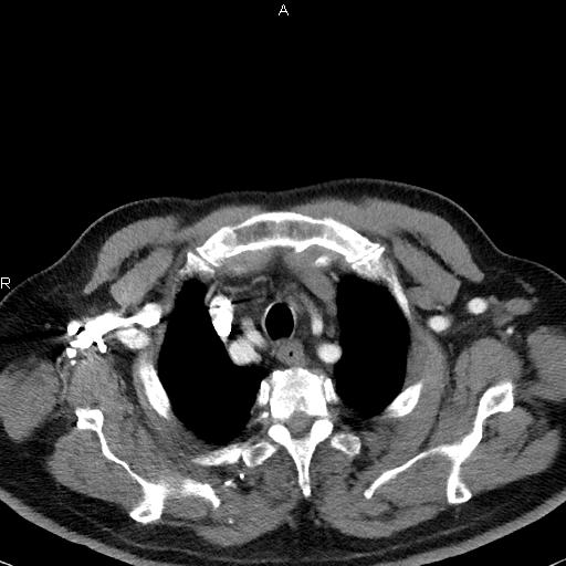 Azygos continuation of the inferior vena cava (Radiopaedia 18537-18404 C+ arterial phase 10).jpg