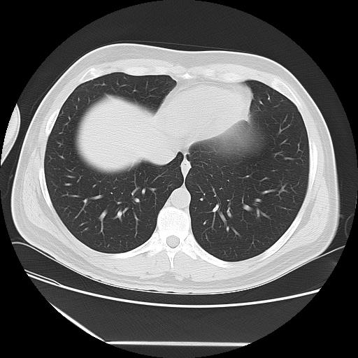 Azygos fissure (Radiopaedia 88181-104784 Axial lung window 40).jpg