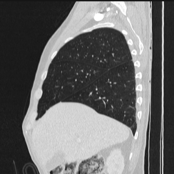 Azygos lobe (Radiopaedia 38259-40275 lung window 24).jpg