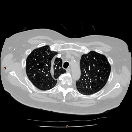 Azygos lobe (Radiopaedia 40161-42821 Axial lung window 13).jpg