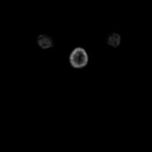 B-cell lymphoma of the mesentery (Radiopaedia 65743-74868 18F-FDG PET-CT 316).jpg