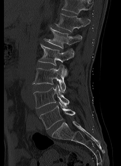 File:Baastrup syndrome (Radiopaedia 64891-73838 Sagittal bone window 5).jpg