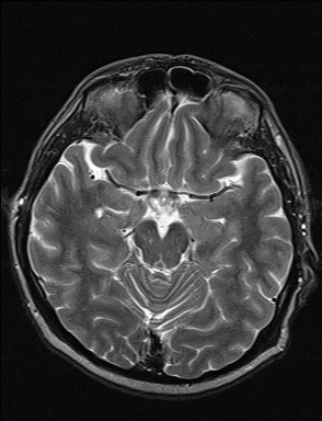 File:Balo concentric sclerosis (Radiopaedia 50458-55940 Axial T2 28).jpg