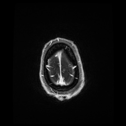 Balo concentric sclerosis (Radiopaedia 53875-59982 Axial LAVA C+ 245).jpg