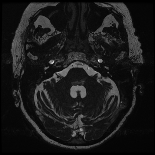 File:Balo concentric sclerosis (Radiopaedia 53875-59982 Axial T2 FIESTA 28).jpg