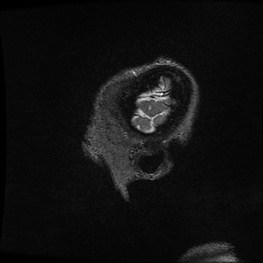 Balo concentric sclerosis (Radiopaedia 53875-59982 Sagittal 3D FSE 7).jpg