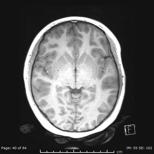 File:Balo concentric sclerosis (Radiopaedia 61637-69636 Axial T1 40).jpg