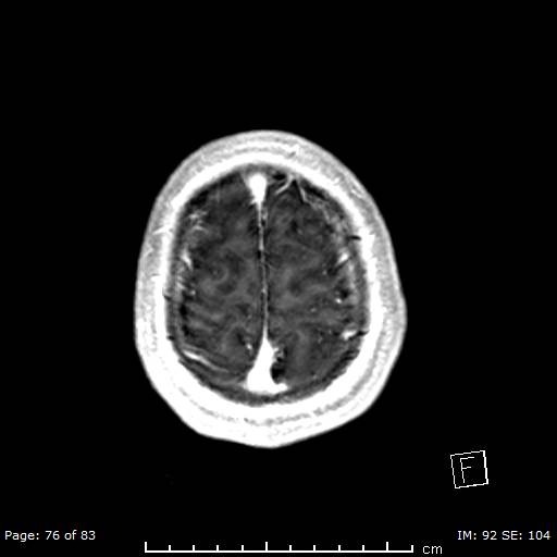 File:Balo concentric sclerosis (Radiopaedia 61637-69636 Axial T1 C+ 76).jpg