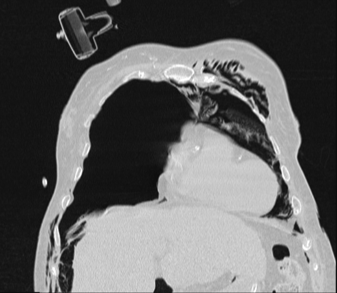 Barotrauma due to mechanical ventilation (Radiopaedia 28079-28336 Coronal lung window 27).jpg