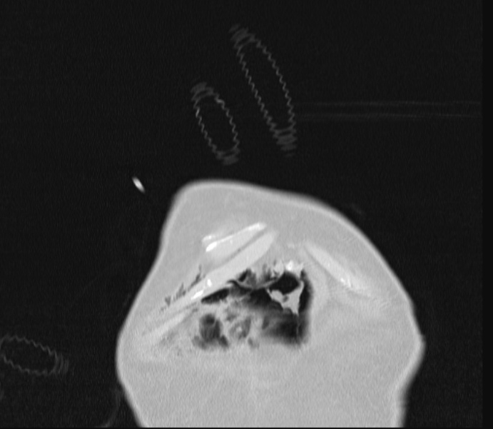 Barotrauma due to mechanical ventilation (Radiopaedia 28079-28336 Coronal lung window 5).jpg