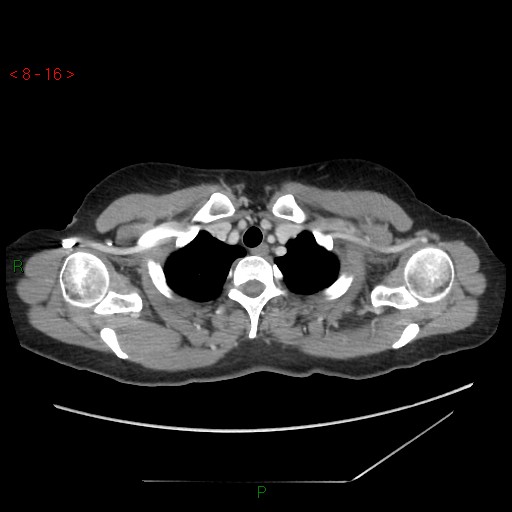 Bartholin gland cyst (Radiopaedia 54904-61181 A 4).jpg