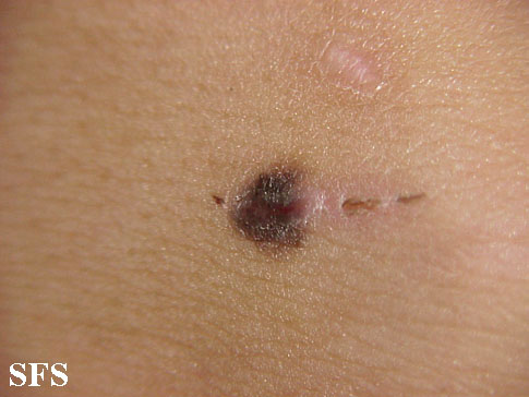 Basal Cell Carcinoma (Dermatology Atlas 46).jpg