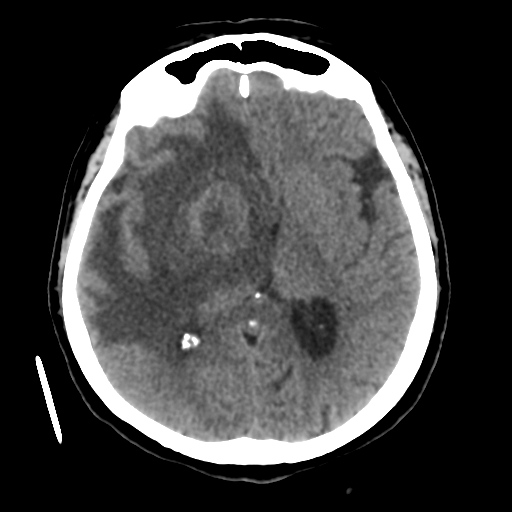 File:Basal ganglia metastasis (Radiopaedia 78928-91830 Axial non-contrast 33).png