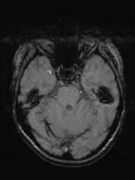 Base of skull chondrosarcoma (Radiopaedia 30410-31070 Axial SWI 19).jpg
