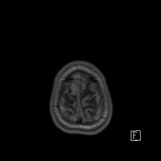 Base of skull rhabdomyosarcoma (Radiopaedia 32196-33142 Axial T1 51).jpg