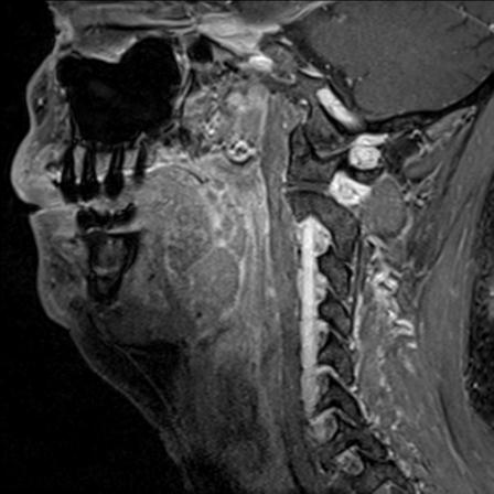 Base of tongue squamous cell carcinoma (Radiopaedia 31174-31884 F 67).jpg
