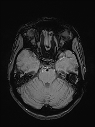 Basilar artery perforator aneurysm (Radiopaedia 82455-97733 Axial SWI 17).jpg