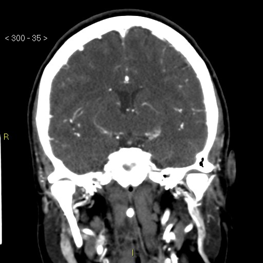 File:Basilar artery thrombosis (Radiopaedia 16260-15944 B 26).jpg