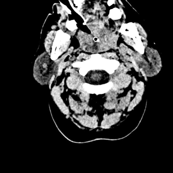 Basilar artery thrombosis (Radiopaedia 53351-59352 Axial non-contrast 7).jpg