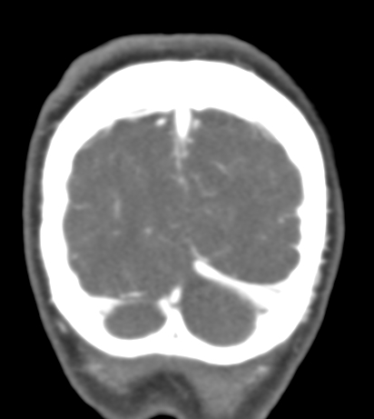 Basilar tip aneurysm with coiling (Radiopaedia 53912-60086 B 146).jpg