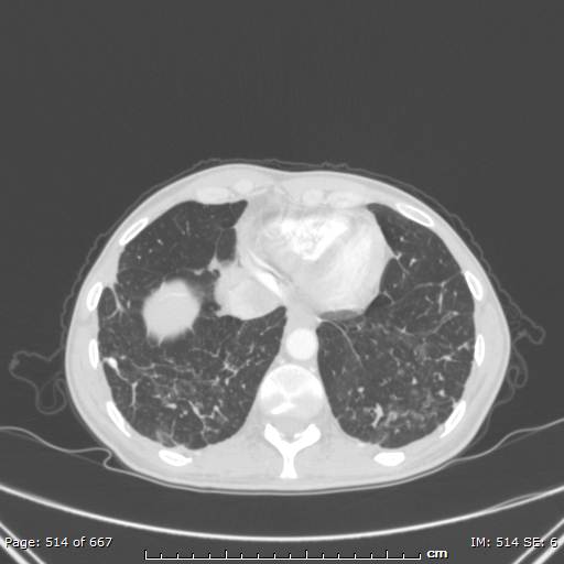 File:Behçet disease (Radiopaedia 44247-47889 Axial lung window 71).jpg