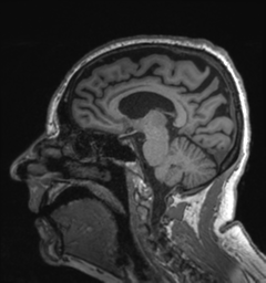 Behavioral variant frontotemporal dementia and late onset schizophrenia (Radiopaedia 52197-58083 Sagittal T1 42).png
