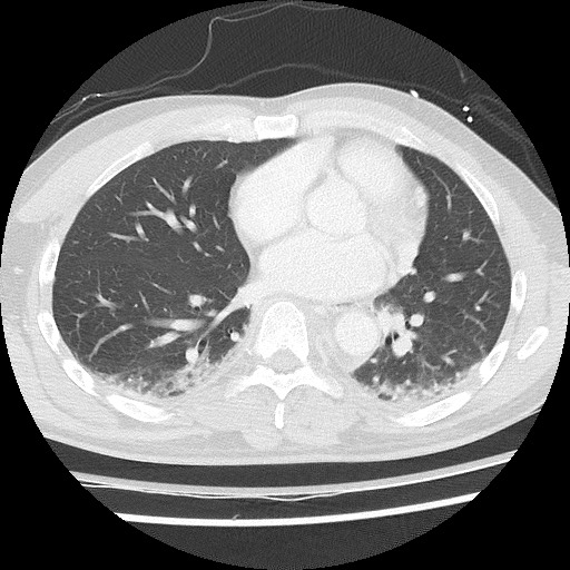 Benign post-traumatic pseudopneumoperitoneum (Radiopaedia 71199-81495 Axial lung window 44).jpg