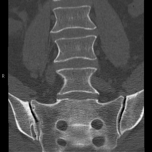 Bertolotti syndrome (Radiopaedia 24864-25128 Coronal bone window 16).jpg