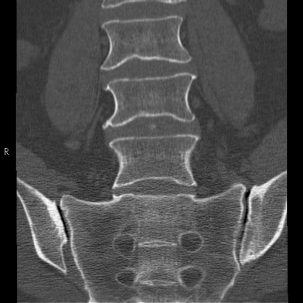 Bertolotti syndrome (Radiopaedia 24864-25128 Coronal bone window 19).jpg