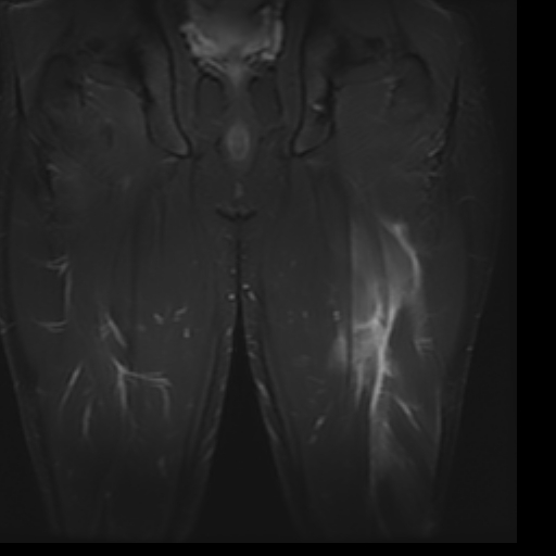 File:Biceps femoris strain injury (Radiopaedia 16800-16515 Coronal STIR 7).jpg