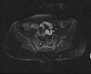 File:Bicornuate bicollis uterus (Radiopaedia 61626-69616 Axial PD fat sat 9).jpg