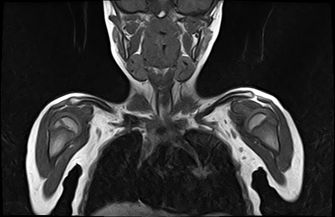 File:Bilateral Sprengel deformity with Klippel-Feil syndrome (Radiopaedia 66395-75650 Coronal T1 7).jpg