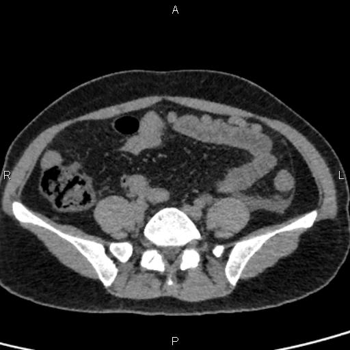 Bilateral adrenal gland hyperenhancement in pancreatitis (Radiopaedia 86642-102753 Axial non-contrast 79).jpg