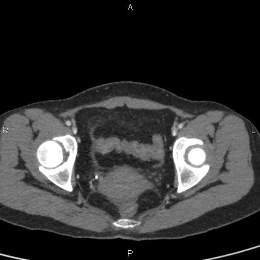 Bilateral adrenal gland hyperenhancement in pancreatitis (Radiopaedia 86642-102753 E 102).jpg