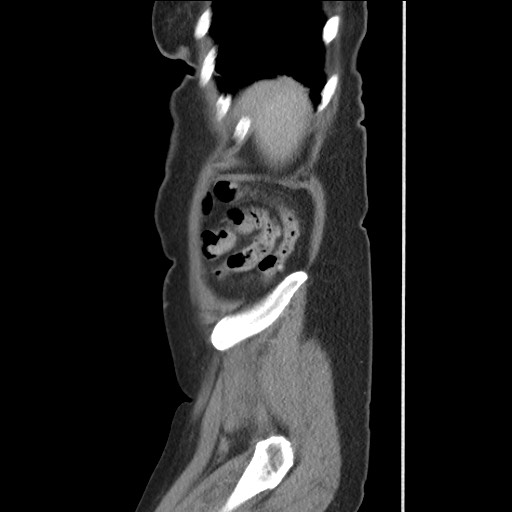 File:Bilateral adrenal granulocytic sarcomas (chloromas) (Radiopaedia 78375-91007 C 120).jpg
