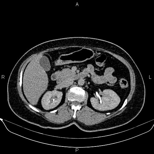 Bilateral benign adrenal adenomas (Radiopaedia 86912-103124 Axial C+ delayed 51).jpg