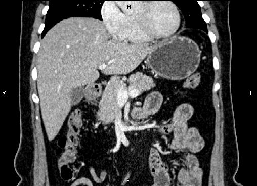 Bilateral benign adrenal adenomas (Radiopaedia 86912-103124 D 21).jpg