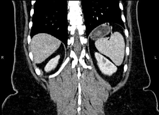 Bilateral benign adrenal adenomas (Radiopaedia 86912-103124 D 53).jpg