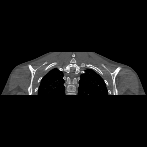 Bilateral chronic posterior shoulder dislocation (Radiopaedia 39213-41452 Coronal bone window 45).jpg