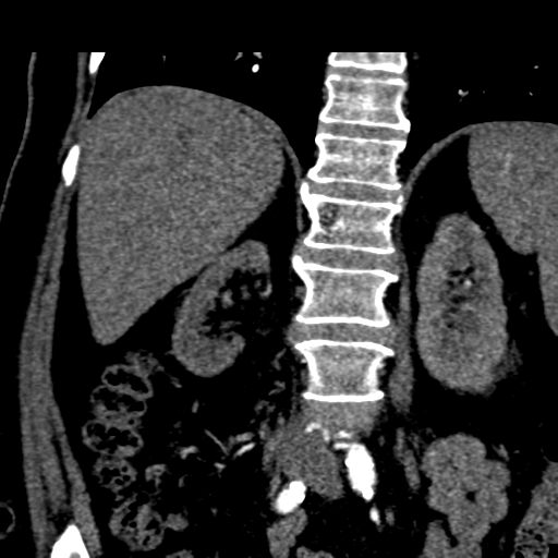 File:Bilateral delayed nephrogram from renal artery stenosis (Radiopaedia 47681-52362 C 10).png