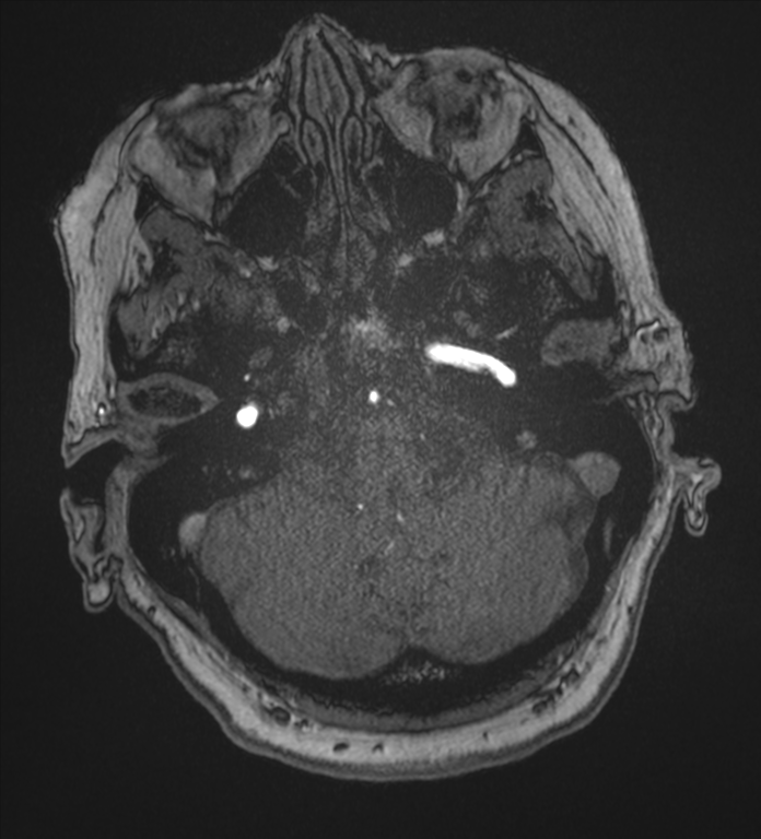 Bilateral fetal posterior communicating arteries (Radiopaedia 41286-44102 Axial MRA 28).png