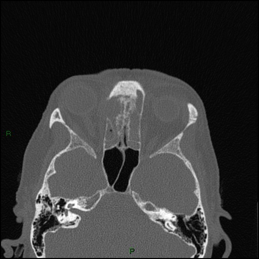 Bilateral frontal mucoceles (Radiopaedia 82352-96454 Axial bone window 137).jpg