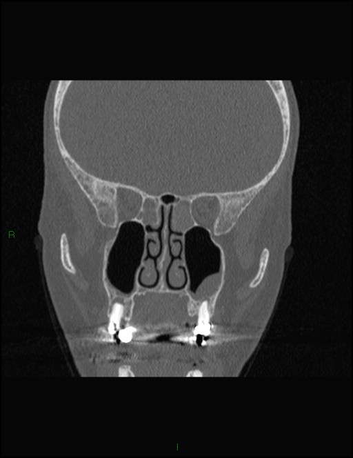 Bilateral frontal mucoceles (Radiopaedia 82352-96454 Coronal 167).jpg