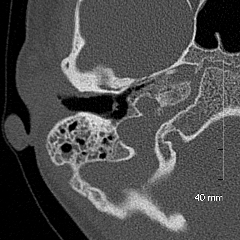Bilateral grommets (Radiopaedia 47710-52404 Axial bone window 25).jpg