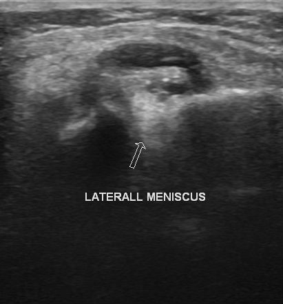 File:Bilateral lateral meniscal cysts (Radiopaedia 12200-12525 C 1).jpg