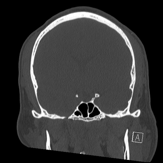 Bilateral occipital condyle fracture (type 2) (Radiopaedia 87675-104089 Coronal bone window 51).jpg