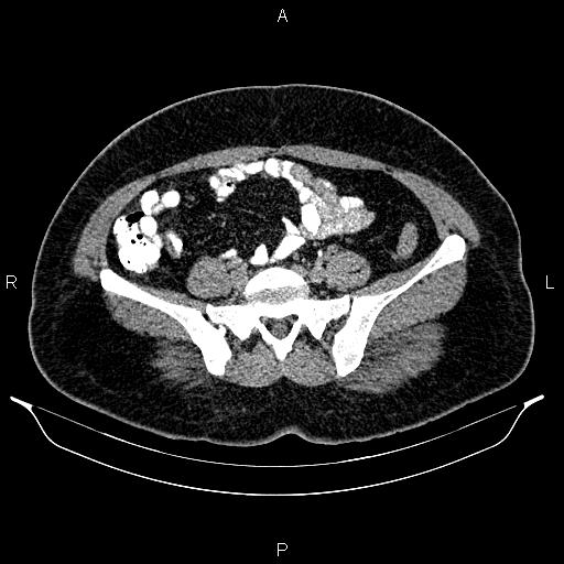 File:Bilateral ovarian dermoid cysts (Radiopaedia 85785-101603 Axial C+ delayed 56).jpg