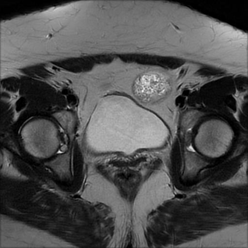 File:Bilateral ovarian dermoid cysts (Radiopaedia 90152-107338 Axial T2 16).jpg