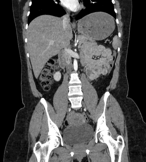 Bilateral ovarian mature cystic teratomas (Radiopaedia 79373-92457 B 35).jpg