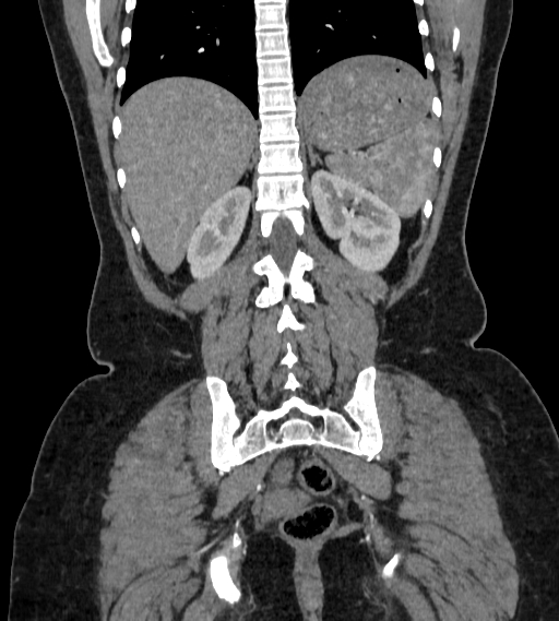 Bilateral ovarian mature cystic teratomas (Radiopaedia 79373-92457 B 75).jpg